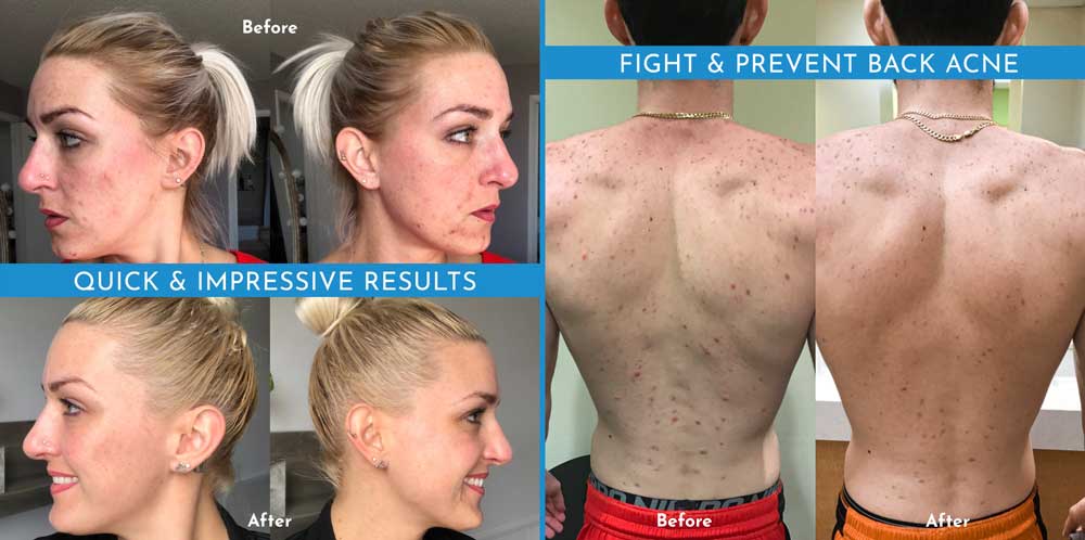truly-clear-acne-bar-before-and-after