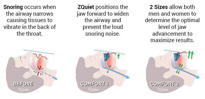 how zquiet works